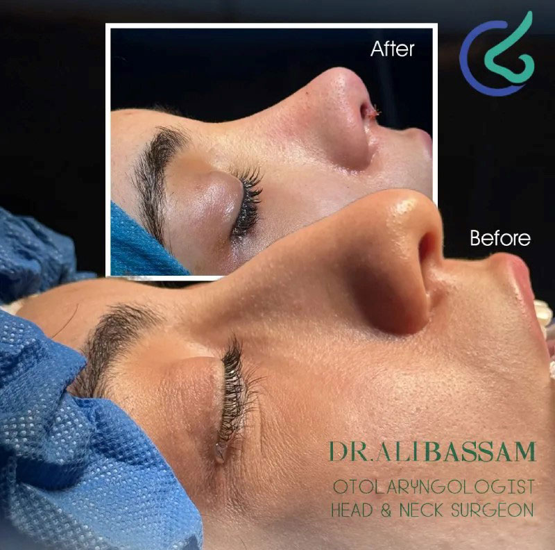 همه چیز درباره عمل بینی طبیعی