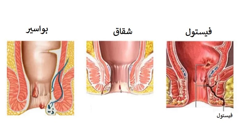 بیماری های مقعدی ناشی از یبوست
